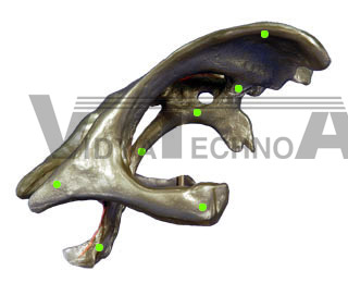 Cerebral Ventricles-Lateral View